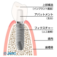 インプラントって？